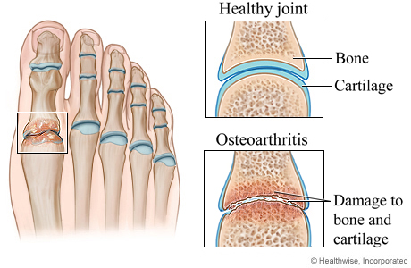 Osteoarthritis of the foot