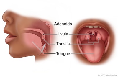 Tonsillitis diagram